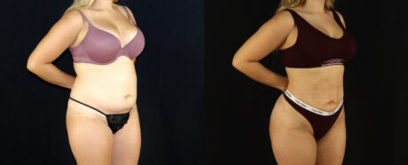 Brazilian Butt Lift case #5174