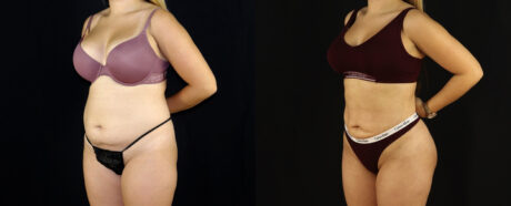 Brazilian Butt Lift case #5174