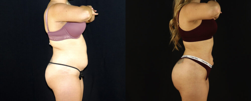 Brazilian Butt Lift case #5174