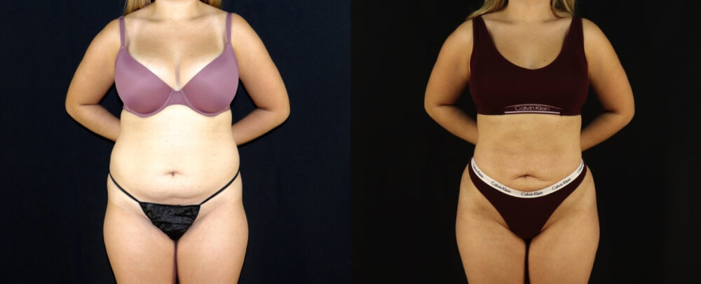 Brazilian Butt Lift case #5174