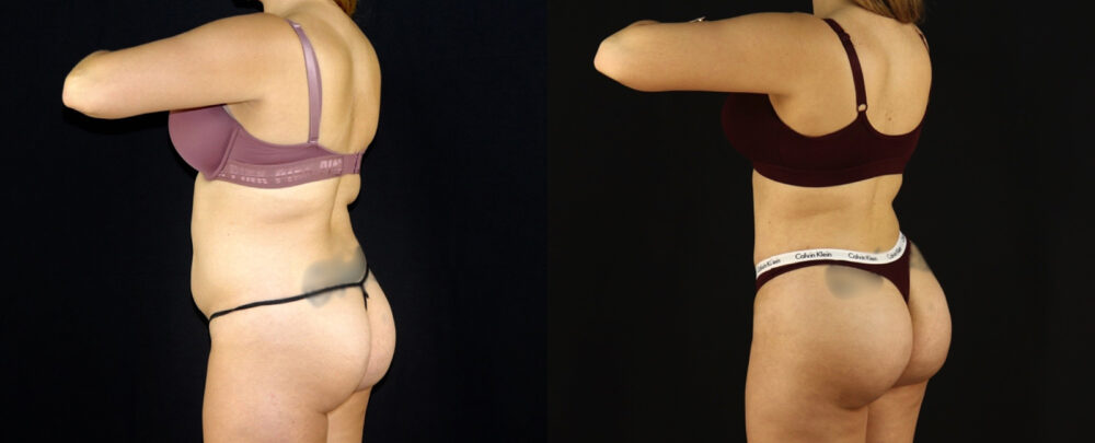 Brazilian Butt Lift case #5174