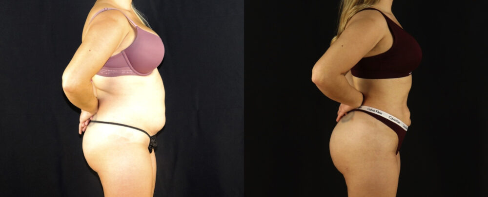 Brazilian Butt Lift case #5174