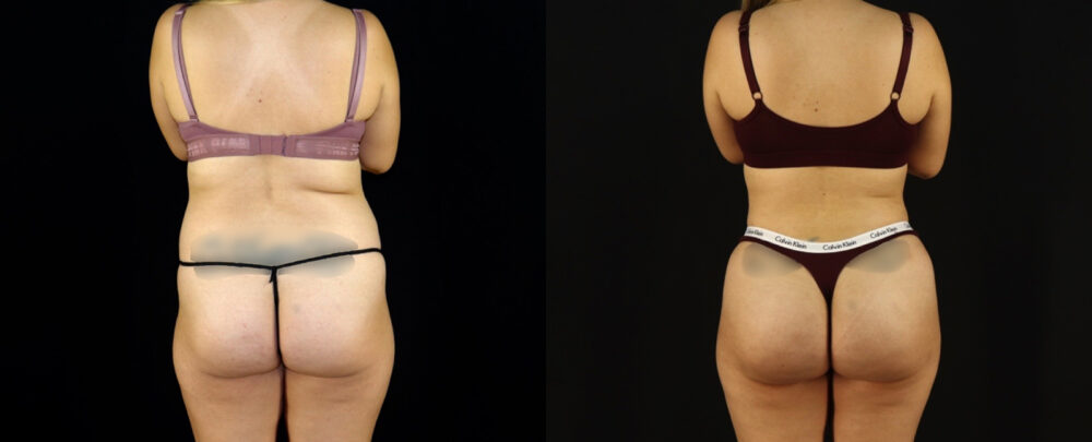 Brazilian Butt Lift case #5174