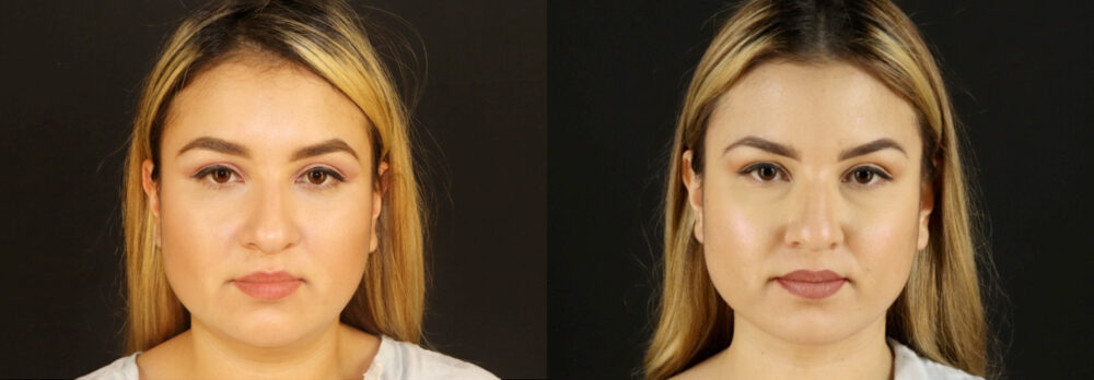 Submental Liposuction case #6949