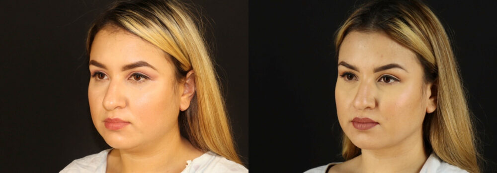 Submental Liposuction case #6949