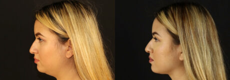 Submental Liposuction case #6949