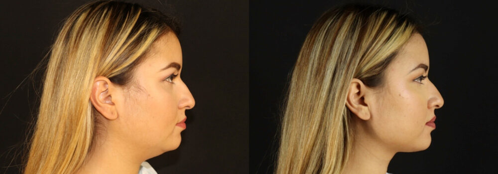 Submental Liposuction case #6949