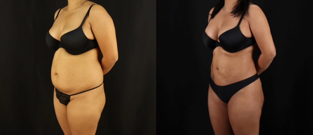 Brazilian Butt Lift case #5175