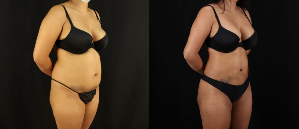 Brazilian Butt Lift case #5175