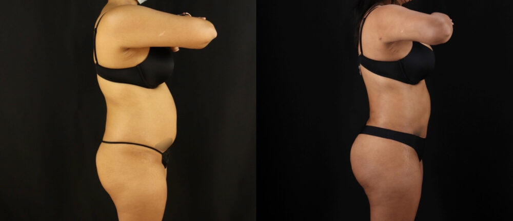 Brazilian Butt Lift case #5175