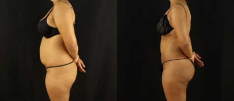 Brazilian Butt Lift case #5175