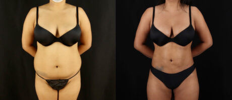 Brazilian Butt Lift case #5175