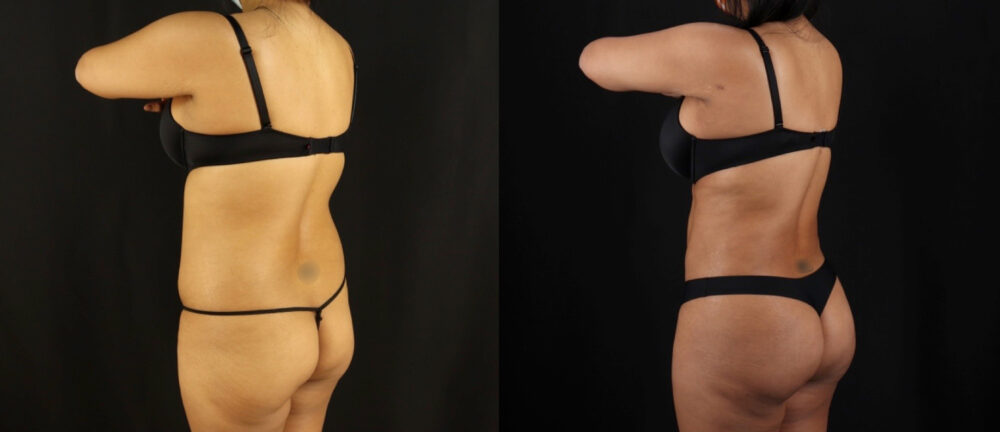 Brazilian Butt Lift case #5175