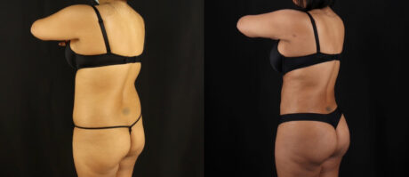 Brazilian Butt Lift case #5175