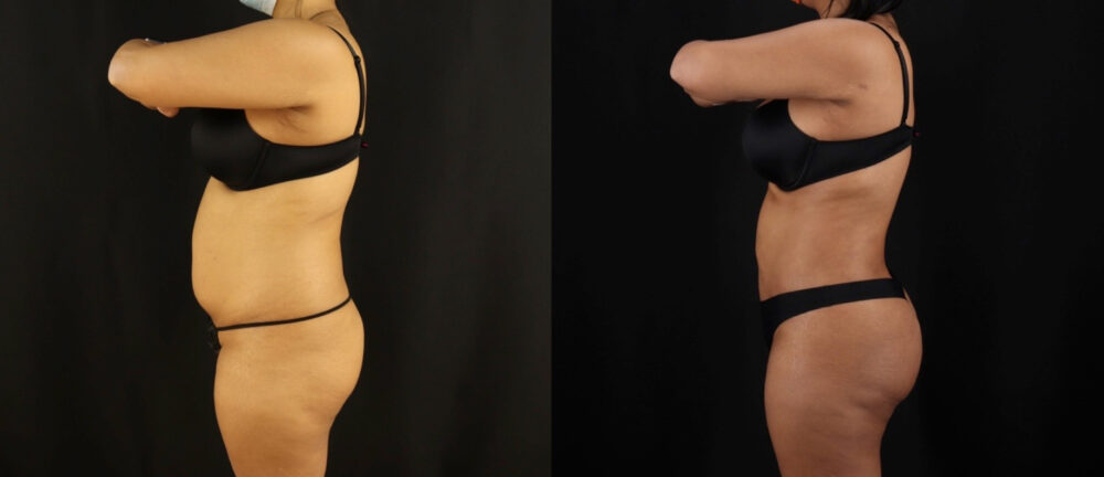 Brazilian Butt Lift case #5175