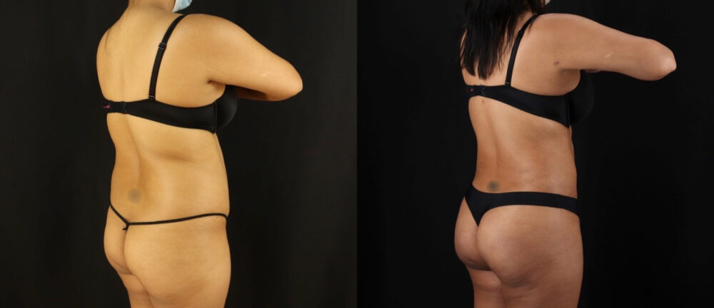 Brazilian Butt Lift case #5175