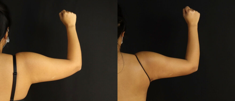 Brazilian Butt Lift case #5175