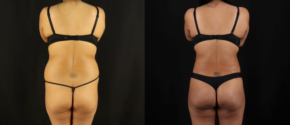 Brazilian Butt Lift case #5175