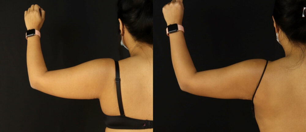 Brazilian Butt Lift case #5175