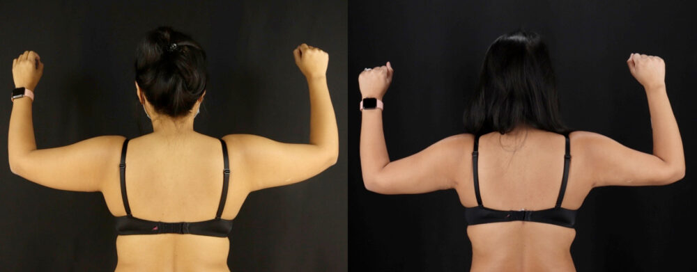 Brazilian Butt Lift case #5175