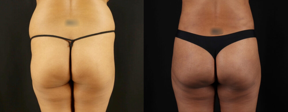 Brazilian Butt Lift case #5175