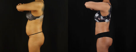 Brazilian Butt Lift case #5263