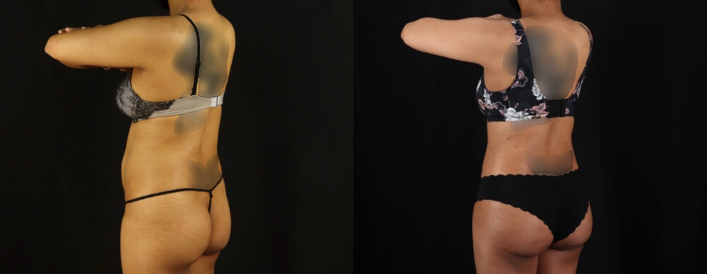 Brazilian Butt Lift case #5263