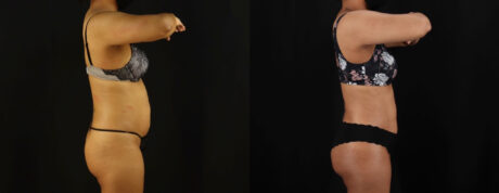 Brazilian Butt Lift case #5263