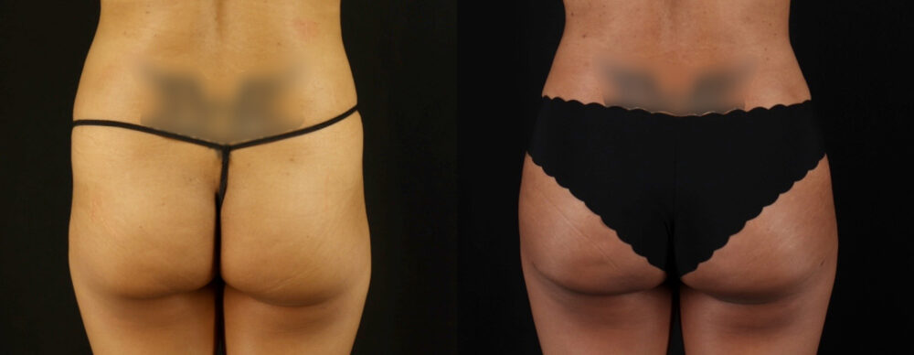 Brazilian Butt Lift case #5263