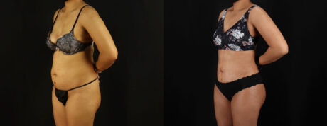 Brazilian Butt Lift case #5263