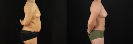 Mommy Makeover case #6525