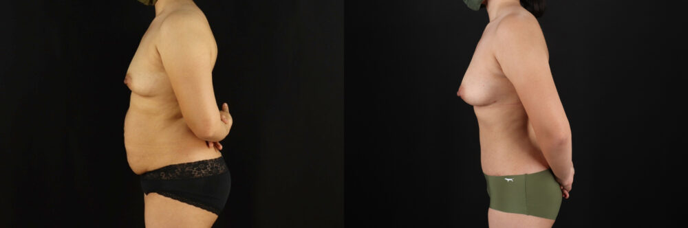 Mommy Makeover case #6525