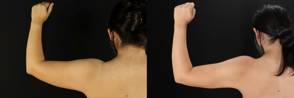 Mommy Makeover case #6525