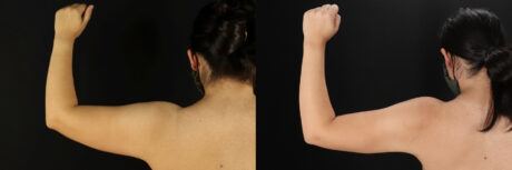 Mommy Makeover case #6525