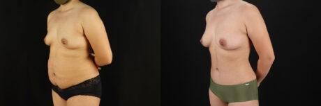 Mommy Makeover case #6525