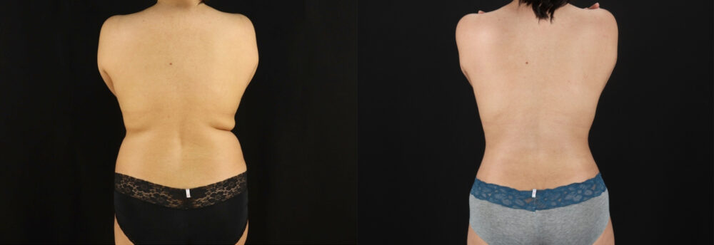 Mommy Makeover case #6525