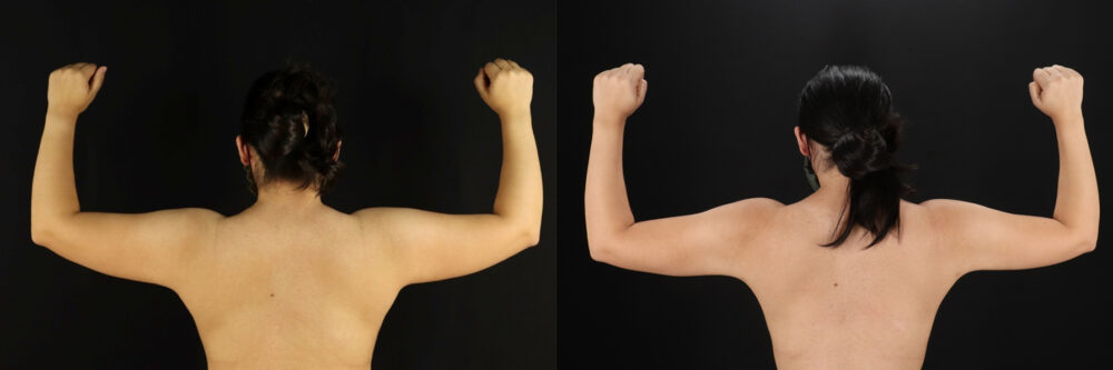 Mommy Makeover case #6525