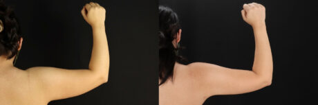 Mommy Makeover case #6525