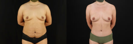 Mommy Makeover case #6525