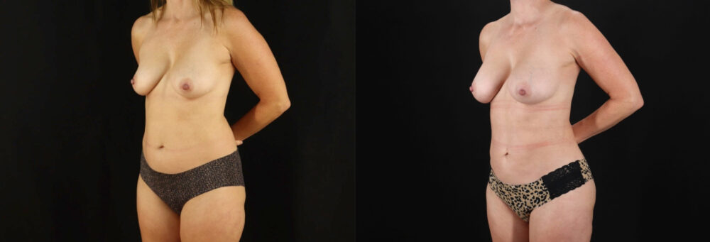 Mommy Makeover case #6519