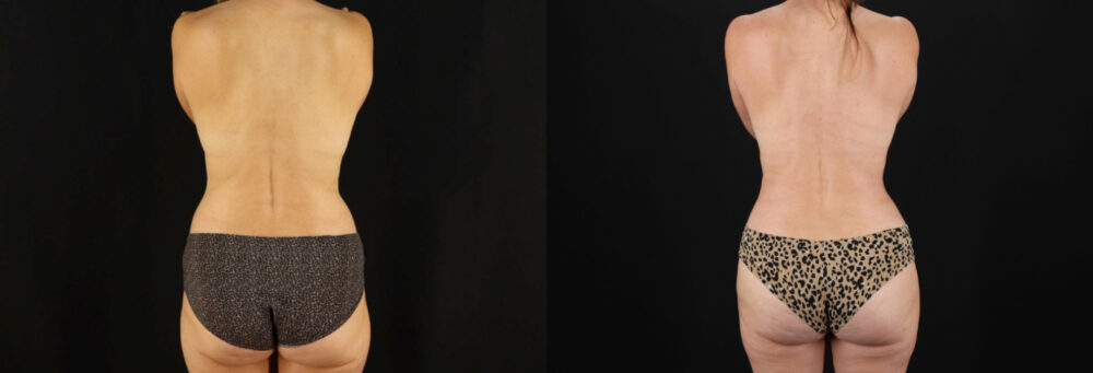 Mommy Makeover case #6519