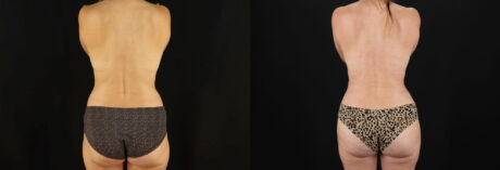 Mommy Makeover case #6519