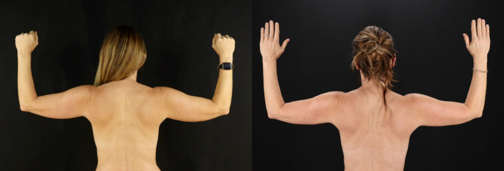 Mommy Makeover case #6519