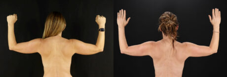 Mommy Makeover case #6519