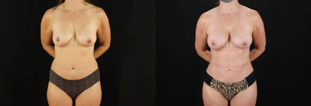 Mommy Makeover case #6519