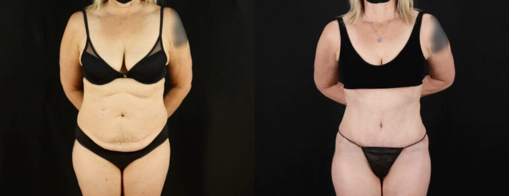 Tummy Tuck case #7351