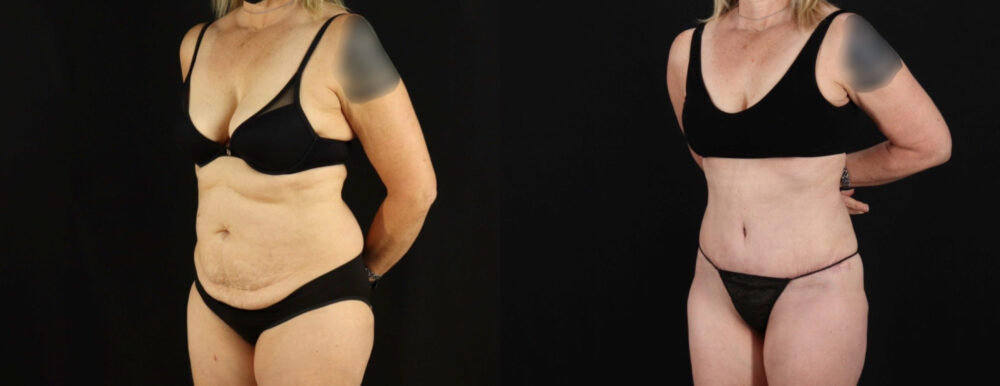 Tummy Tuck case #7351