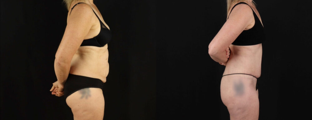 Tummy Tuck case #7351