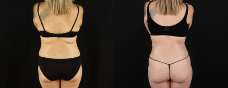 Tummy Tuck case #7351