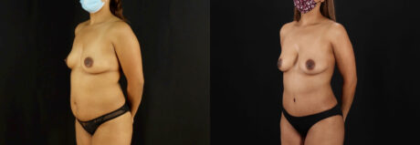 Mommy Makeover case #6521